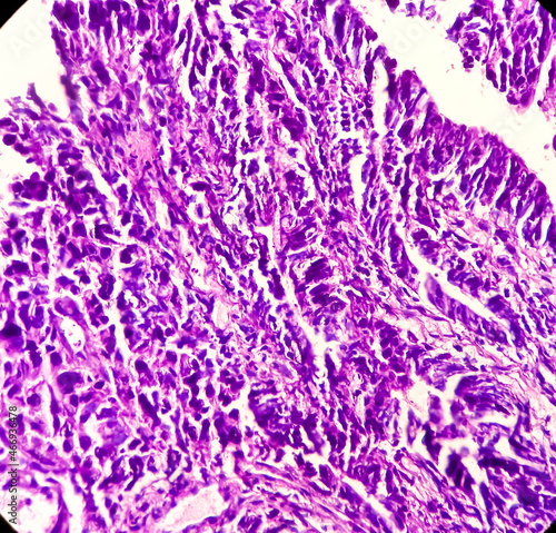 Colon Cancer: Photomicrograph (microscopic image) of colorectum adenocarcinoma,Light microscope 200x showing rectum adenocarcinoma photo