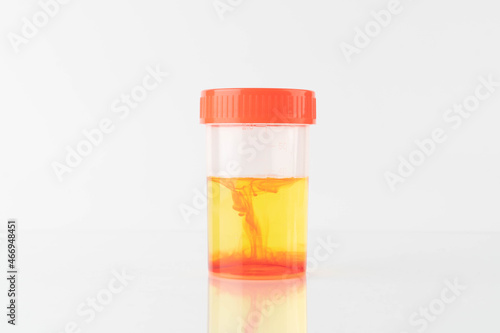 Blood in urine (hematuria) sample bottle in laboratory. Cause of hematuria included urinary tract infection, kidney infection, bladder stone, prostatitis or cancer.