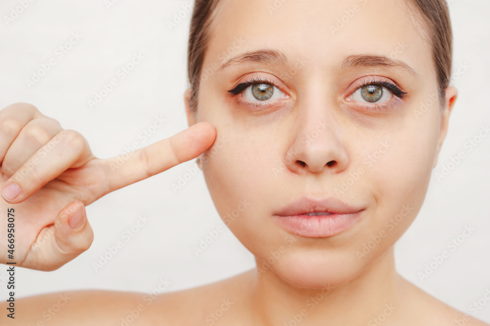 A young caucasian woman pointing dark circles under the eyes with her finger. Bruises under the eyes are caused by fatigue, nervousness, lack of sleep, insomnia and stress. Skin care, cosmetology A young caucasian woman pointing dark circles under the eyes with her finger. Bruises under the eyes are caused by fatigue, nervousness, lack of sleep, insomnia and stress. Skin care, cosmetology