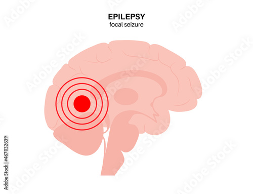 epilepsy seizure concept