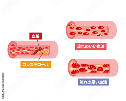 血管のトラブルの断面イメージ