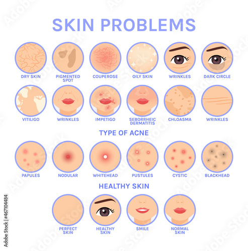 Skin Problems. Set of Icons for Different Skin Diseases of Face. Before After. Healthy Perfect Clean skin. Illustration for Medical and Cosmetic Design. White background. Flat Cartoon style. Vector.