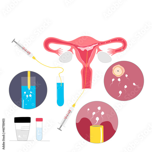 Intrauterine donor insemination vector colored illustration