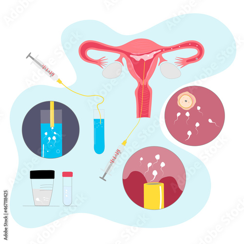 Intrauterine donor insemination vector colored illustration