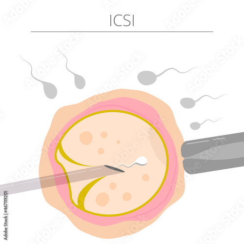 Vector colored  illustration intracytoplasmic sperm injection, ICSI, as part of IVF process