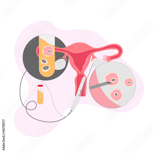 Vector colored illustration Egg retrieval. Egg donation. Donor. In vitro fertilization.