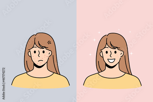 Skin problem and health concept. Stressed unhappy young woman with red acne pimples and smiling with healthy skin face vector illustration 