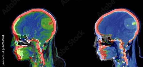 Coloured sagital head ct scan showing brain tumor photo