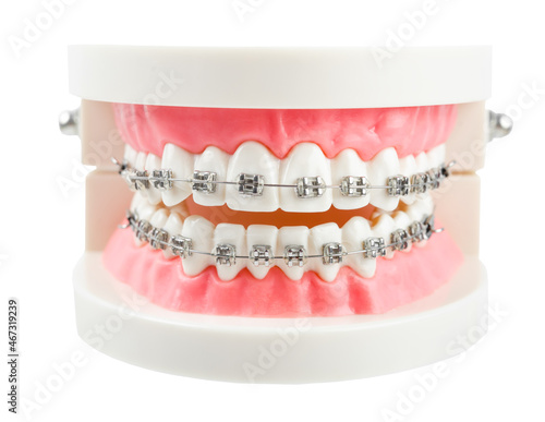 Teeth model wire dental braces isolated on white background.