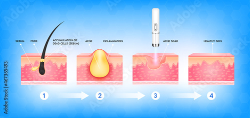 Acne scar vascular laser treatment. Inflammation associated with pimples. The structure of the skin acne scar. Medical beauty skin care concept. 3D vector illustration.