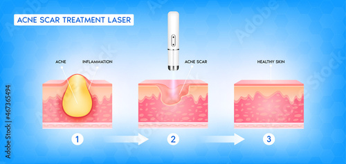 Acne scar vascular laser treatment. Inflammation associated with pimples. The structure of the skin acne scar. Medical beauty skin care concept. 3D vector illustration.