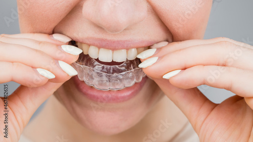 Close-up portrait of a woman putting on a transparent plastic retainer. A girl corrects a bite with the help of an orthodontic device
