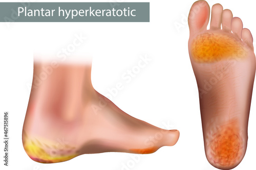 Plantar or Palmoplantar hyperkeratosis. Keratoderma. Vector illustration of Plantar Hyperkeratosis of the foot with dry sole skin and cracked heel. photo