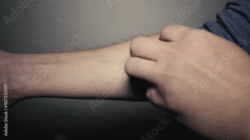 Man suffering from itching hand skin and scratching an itchy place. Allergic reaction to insect bites, dermatitis, food and medicine. Allergy rash, morbilli, chickenpox or other skin conditions