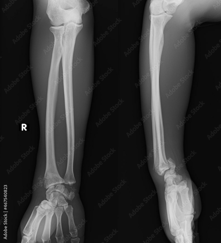smith fracture
