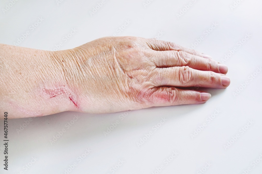 one hand of an elderly woman with scratches and bruises close-up one hand of an elderly woman with scratches and bruises close-up