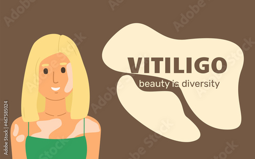 Web template with woman with vitiligo. The concept of different beauty, body positive, self-acceptance. Banner with title Vitiligo. Beauty is diversity.