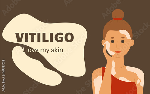 Web template with woman with vitiligo. The concept of different beauty, body positive, self-acceptance. Banner with title Vitiligo. Beauty is diversity.
