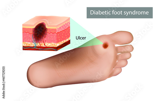 Diabetic foot syndrome ulcer. Destruction of deep tissues of the foot. Medical illustration photo