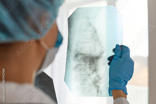 Closeup back side shot of woman doctor in medical cap and blue gloves, radilogist holding x-ray, holding radiology picture, thinking about illness and its trreatment, health care. photo