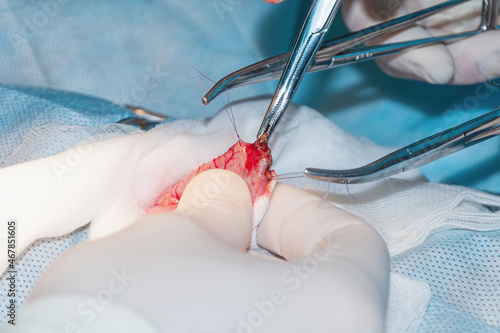 Canvas Print The surgical  process of removal of a foreign body from the intestine