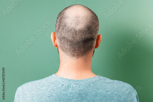 Back view of baldness man. Rear view. Green background. Copy space. The concept of alopecia and aesthetic medicine