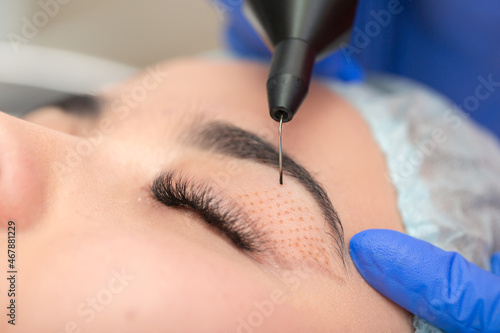 Cosmetic procedure for lifting the skin of the eyelids of Asian eyes. Non-surgical blepharoplasty with plasma IQ apparatus. Facial rejuvenation cosmetology. Beautician makes a cosmetic procedure.