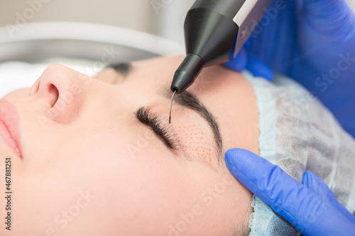 Cosmetic procedure for lifting the skin of the eyelids of Asian eyes. Non-surgical blepharoplasty with plasma IQ apparatus. Facial rejuvenation cosmetology. Beautician makes a cosmetic procedure.