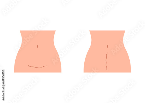 Scar on stomach woman after cesarean. Woman s belly, consequence cesarean operation. Motherhood, childbirth. Vector illustration