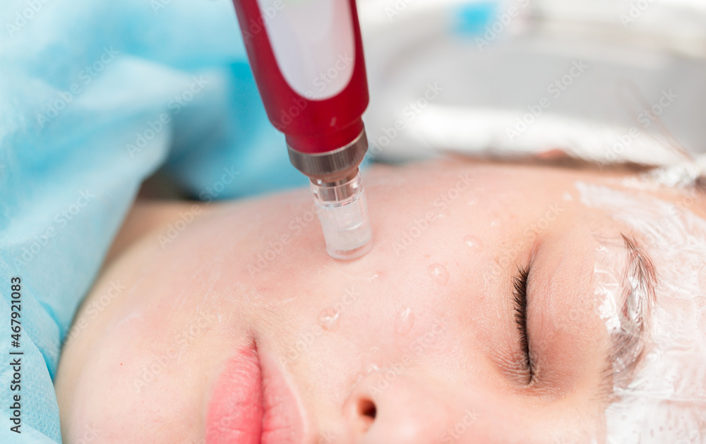 Fototapeta premium Cosmetology mesotherapy for facial rejuvenation. Mikronidling cosmetic procedure. The beautician injects hiluronic acid in the face of the girl's patient with the help of a dermopen wrinkle remover.