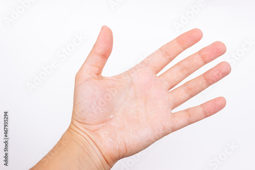 Close-up of a female hand with peeling skin on the palm isolated on a white background. Allergies, eczema, psoriasis, vitamin deficiency, erythema