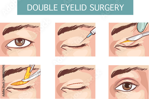 Vector Illustrated set with double eyelid surgery.