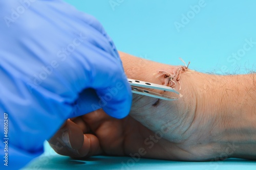 Φωτογραφία Doctor examining nerve conduction on palm of hand after carpal tunnel syndrome