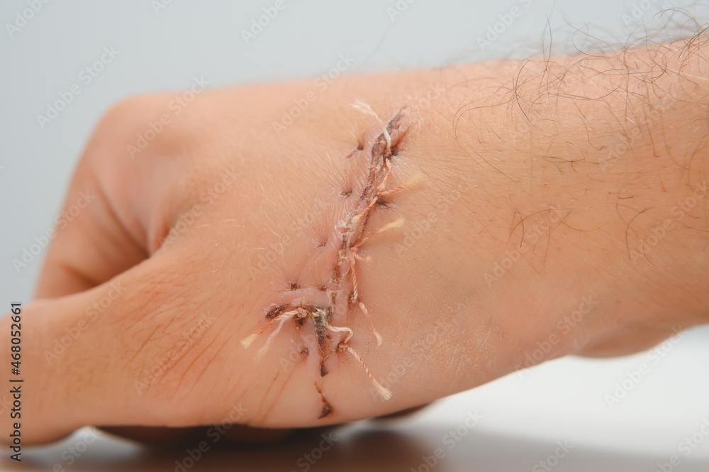 Obraz premium wound hand, suturing the wound. The type of cut after surgery.