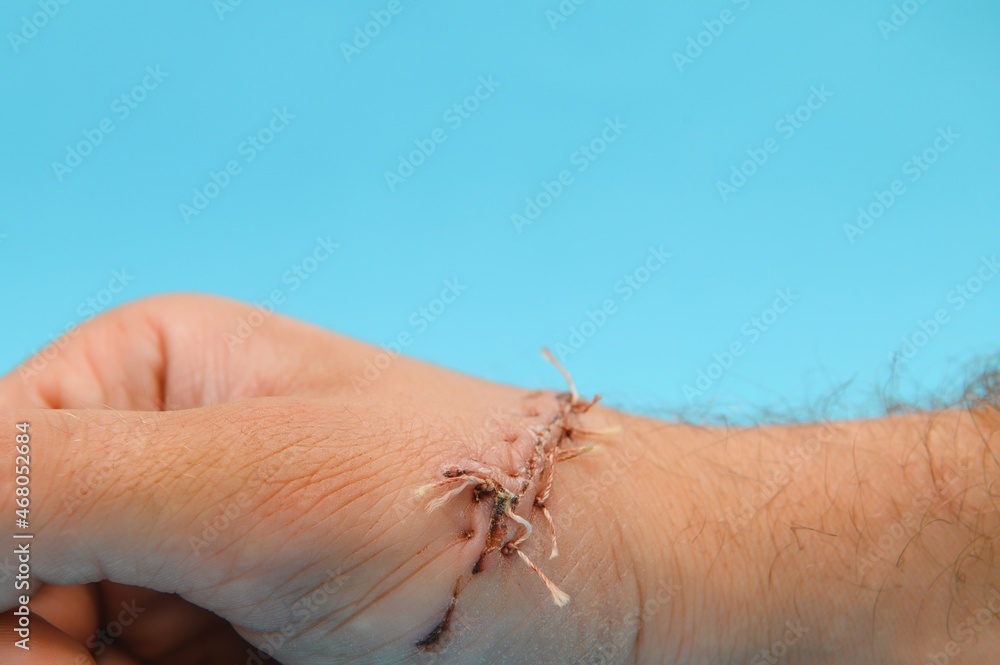 Obraz premium Close-up of a hand wound with stitches