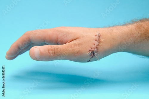 wound hand, suturing the wound. The type of cut after surgery.