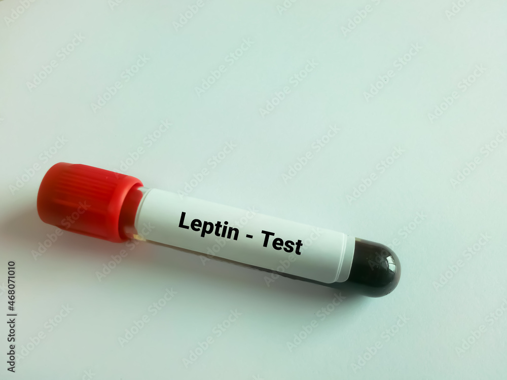 Blood sample for Leptin test. This test measures the amount of leptin in the blood to detect a deficiency that may be contributing to obesity. Blood sample for Leptin test. This test measures the amount of leptin in the blood to detect a deficiency that may be contributing to obesity.