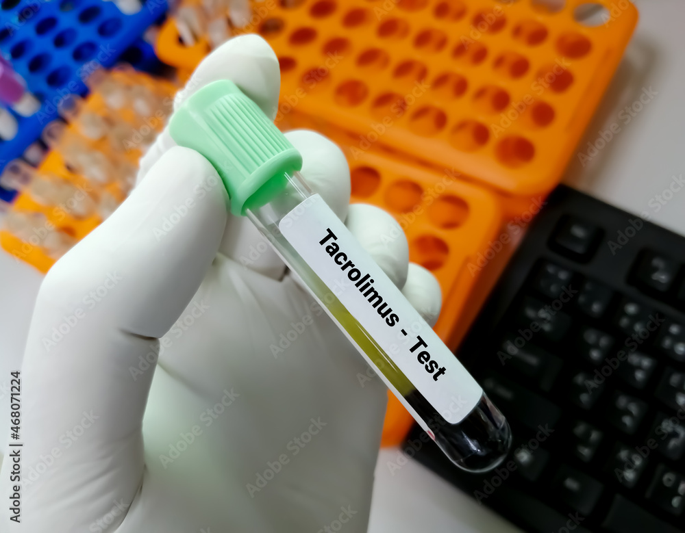 Technician hold blood sample with black background for Tacrolimus level test, immunosuppressive drug Technician hold blood sample with black background for Tacrolimus level test, immunosuppressive drug