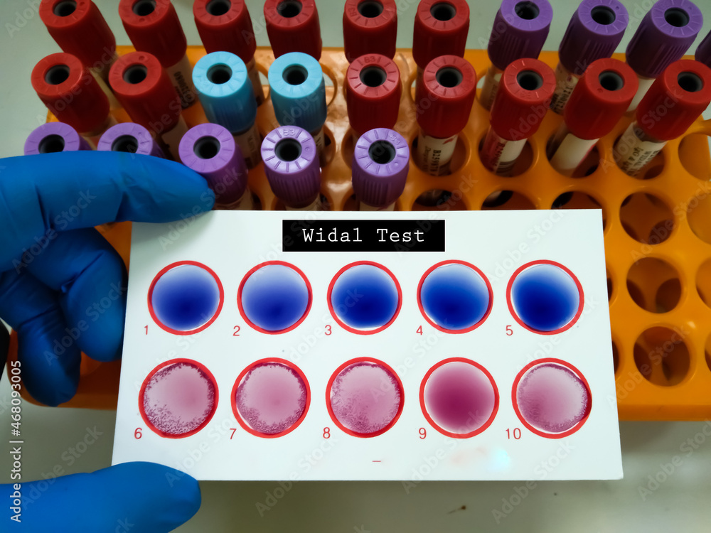 Widal test by agglutination method at plate isolated on white