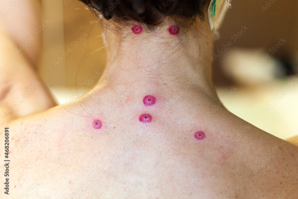 Hirudotherapy, leech bite marks on the girl's back Stock Photo