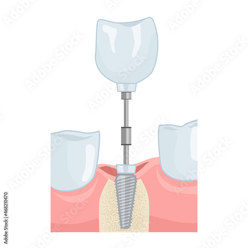 Dental implant insertion. Dental services. Vector illustration for dental textbooks