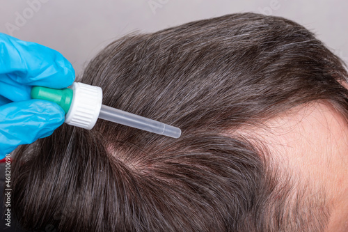 A doctor in blue medical gloves drips with a pipette strengthening drops on the hair roots for the treatment