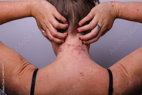 severe exacerbation of atopic dermatitis on the girl's neck. dermatology. skin problems photo