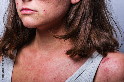 a young girl with atopic dermatitis in the acute stage. redness and scratching up to blood on the body close-up. dermatology photo