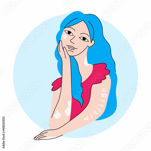 Smiling woman with vitiligo skin desease