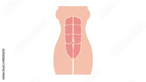 Formation of diastasis recti animation  from normal toned abdomen muscles, also known as abdominal separation, common among pregnant women 