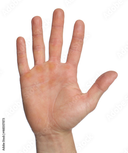 Man suffering from calluses on hand against white background, closeup