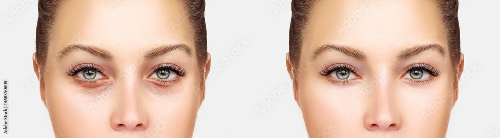 Naklejka premium Lower and upper Blepharoplasty.Marking the face.Perforation lines on females face, plastic surgery concept.