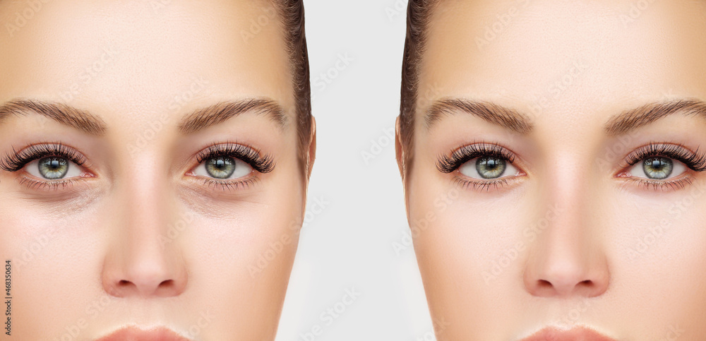 Fototapeta premium Lower eyelid blepharoplasty.Upper blepharoplasty.Before and after cosmetic procedures
