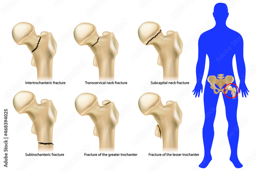 Femoral neck fracture. Types of hip fractures. Subtrochanteric, Intertrochanteric, Transcervical and Subcapital  neck fracture, Fracture of the greater and lesser trochanter. Anatomy - obrazy, fototapety, plakaty 
